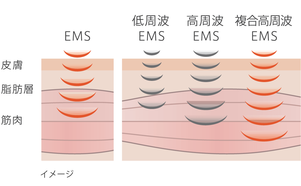 複合高周波EMS